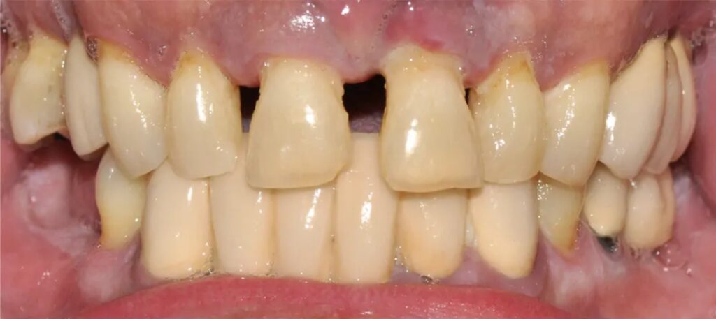 foto dientes antes de protesis con riet plus clinica cali colombia implantes diseño de sonrisa