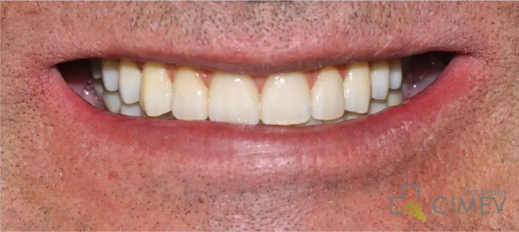 foto dientes despues de protesis con riet plus clinica cali colombia implantes diseño de sonrisa